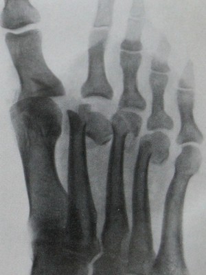 Перелом головок I и IV плюсневых костей с вывихом I и II пальцев стопы - снимок в косой проекции