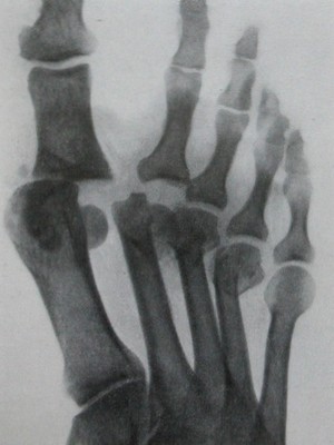 Перелом головок I и IV плюсневых костей с вывихом I и II пальцев стопы - снимок в прямой проекции