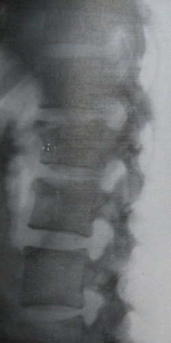 Рентгеновский снимок перелома 1 и 2 поясничных позвонков в боковой проекции
