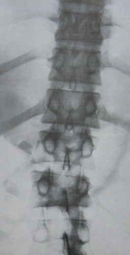 Рентгеновский снимок перелома 1 и 2 поясничных позвонков в задней проекции