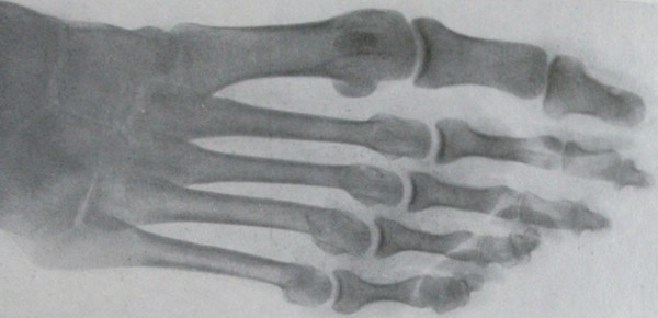 Тыльно-подошвенный рентгеновский снимок поперечного перелома III-V плюсневых костей