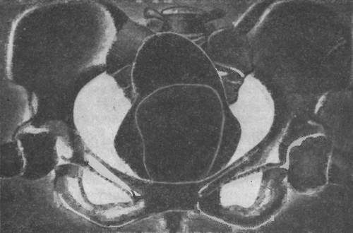 Рентгенограмма вагинального грязевого тампона, комбинированного с ректальным