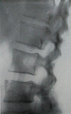 Рентгеновский снимок отделения передне-верхнего края 3 поясничного позвонка в боковой проекции