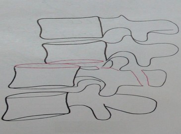 Схема к рентгеновскому снимку переломо-вывиха 2 и 3 поясничных позвонков в боковой проекции