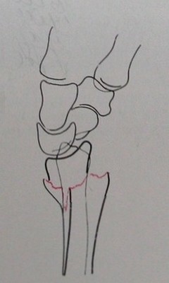 Схема к рентгеновскому снимку типичного перелома лучевой кости со смещением в боковой проекции