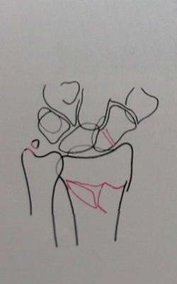 Схема рентгеновскому снимку типичного перелома лучевой кости со смещением в ладонной проекции