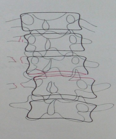 Схема к рентгеновскому снимку переломо-вывиха 2 и 3 поясничных позвонков в задней проекции