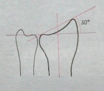 Схематическое изображение угла наклона проксимальной плоскости лучезапястного сустава на заднем снимке