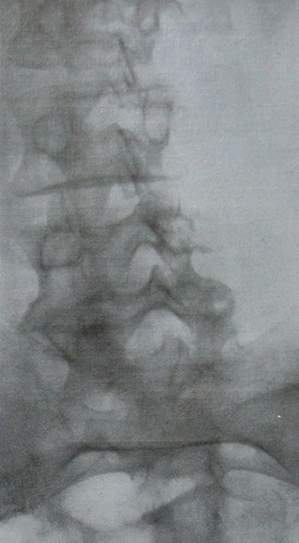 Рентгеновский снимок перелома pars interarticularis 4 поясничного позвонка с вывихом в задней проекции
