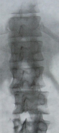 Рентгеновский снимок переломо-вывиха 2 и 3 поясничных позвонков в задней проекции