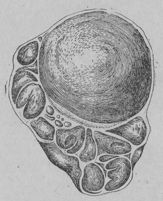 Железистая киста яичника (коллоидная) - cystoma glandulare