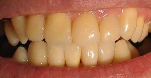 Желтые зубы и их отбеливание