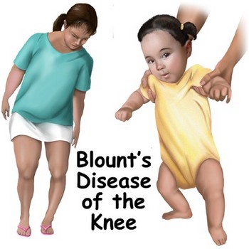 Болезнь Бланта (деформирующий остеохондроз большеберцовой кости) у детей
