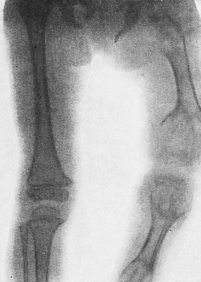 Болезнь Оллье - дисхондроплазия. Изменения в длинных трубчатых костях у ребенка 10 лет.