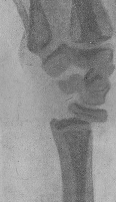 Эпифизеолиз нижнего конца лучевой кости