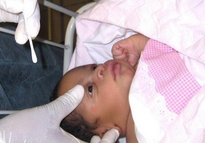 Офтальмия новорожденных - инфекционная болезнь глаз
