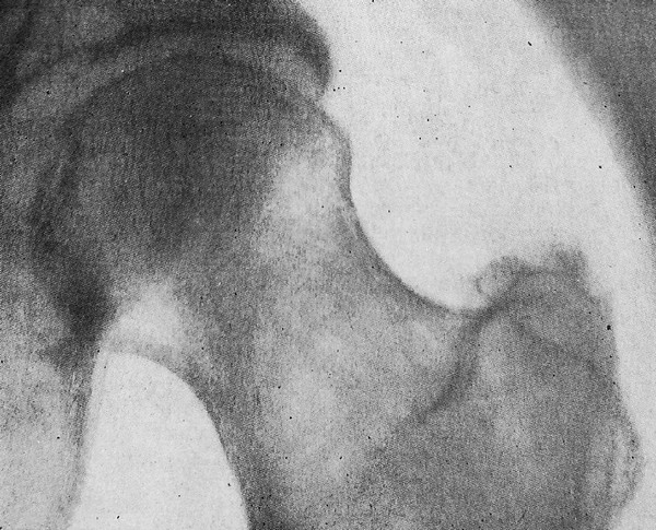 Окостенение сухожилия (тендиноз) области большого вертела