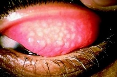 Трахома - инфекционная болезнь глаз