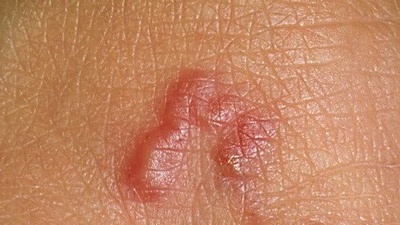 Гельминт анкилостомидоз под кожей