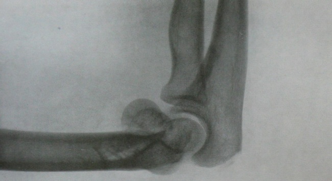 Рентгеновский снимок перелома головки плечевой кости и блока в боковой проекции
