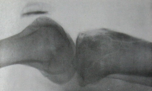Двумыщелковый перелом большеберцовой кости с вдавлением на рентгеновском снимке в боковой проекции