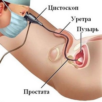 Цистоскопия - метод извлечения инородных тел из мочеполовых путях