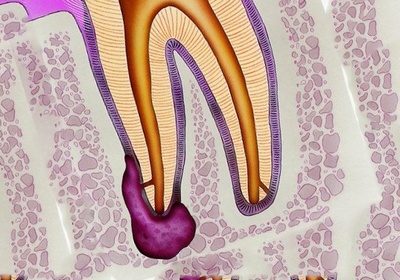 Изображение корневой кисты зуба
