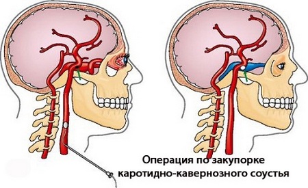 Ликвидация свища между сонной артерией и пещеристым синусом Малоинвазивное нейрохирургическое вмешательство по закрытию свища между сонной артерией и пещеристым синусом