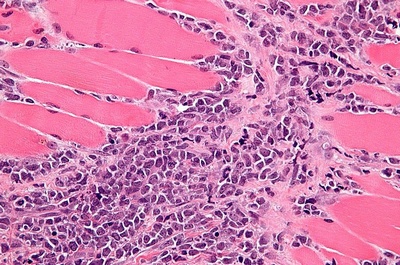 Микрофотография хлоромы в ткани мышцы
