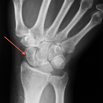 Перелом ладьевидной кости на рентгеновском снимке