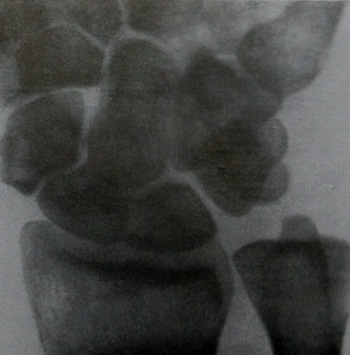 Рентгеновский снимок псевдоартроза ладьевидной кости