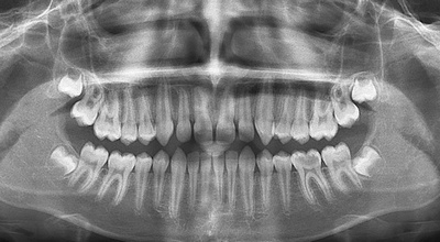 Панорамный рентгеновский снимок зубов
