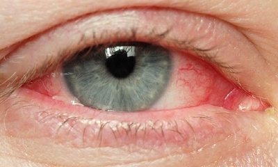 Контактные линзы - причина возникновения синдрома сухого глаза
