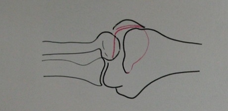 Схема к рентгеновскому снимку перелома головки плечевой кости и блока в задней проекции