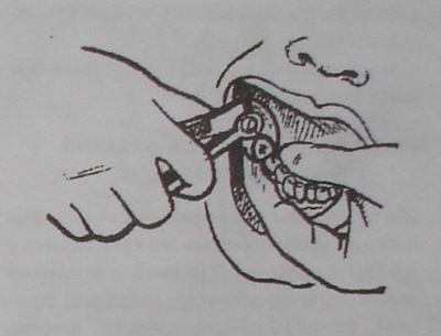 Техника удаления третьего моляра (зуба мудрости) нижней челюсти справа