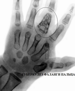 Туберкулез фаланги пальца