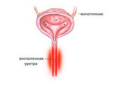 Хроническое воспаление задней уретры - одна из причин сперматореи