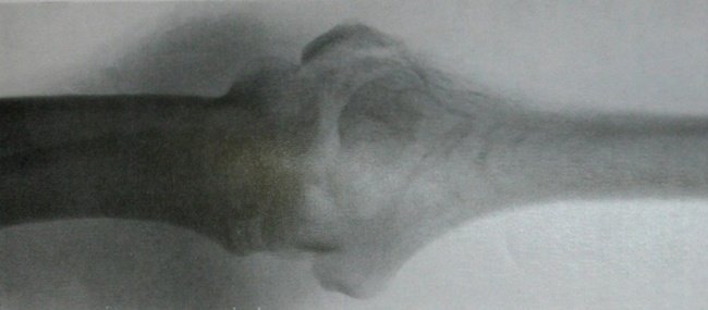 Рентгеновский снимок перелома головки плечевой кости и блока в задней проекции
