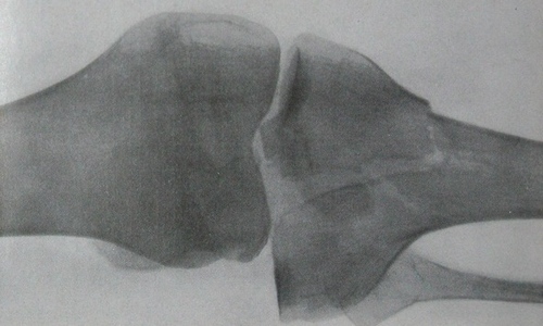 Двумыщелковый перелом большеберцовой кости с вдавлением на рентгеновском снимке в задней проекции