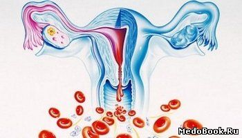 Меноррагия - усиление 
менструации