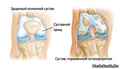 Сравнение здорового коленного сустава и коленного сустава с 
остеоартритом