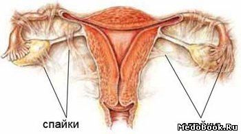 Спаечный процесс женских половых органов