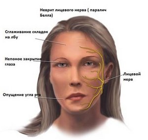 Болевой синдром при неврите лицевого нерва