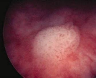 Эндоскопическая картина лейкоплакии мочевого пузыря