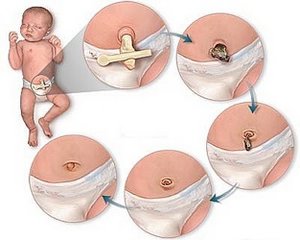 Обработка пупочной ранки у новорожденного