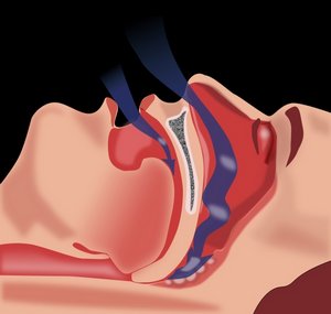 Обструкция дыхательных путей во сне при обструктивном апноэ