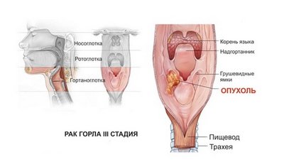 Рак гортани III стадии