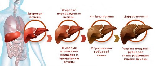Изменения на разных стадиях цирроза печени