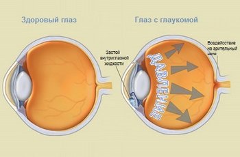 Повышение давление в глазу при разных видах глаукомы