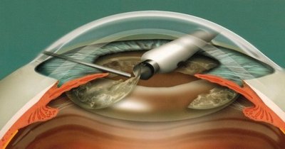 Факоэмульсификация в детской офтальмологии - один из способов лечения врожденной катаракты